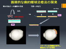 3D MRI画像解析による「病的近視」の原因解明