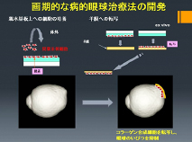 3D MRI画像解析による「病的近視」の原因解明