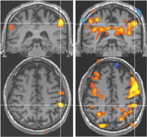 神経障害性疼痛患者のfMRI。左：健常側刺激、右：患側刺激。