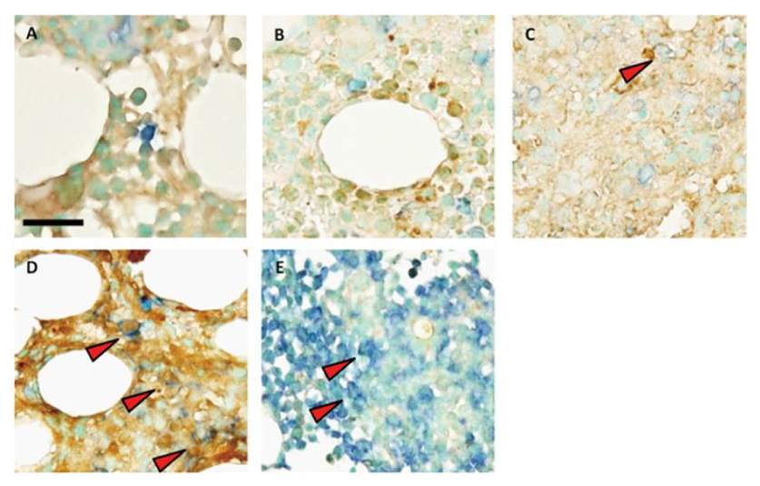 抗アポトーシスタンパク（MCL-1;茶）と造血幹細胞マーカー（CD34;青）の免疫二重染色