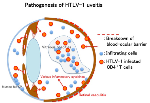 レトロウイルスの研究：HTLV-1 ぶどう膜炎の発症機構のシェーマ
