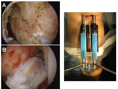 2重束前十字靭帯再建術における移植腱の固定角度の影響に対する検討：大腿骨骨孔位置（左）と張力設定器