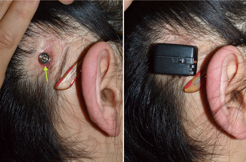 埋め込み型骨導補聴器インプラント（左）とサウンドプロセッサー（右）