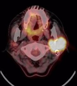 耳下腺原発悪性リンパ腫のFDG-PET/CT画像
