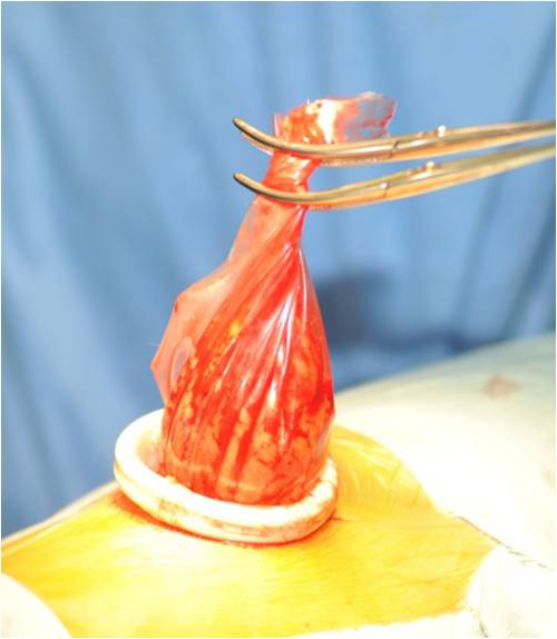 ミニマム創内視鏡下根治的腎摘除術（3cmのシングルポート手術）